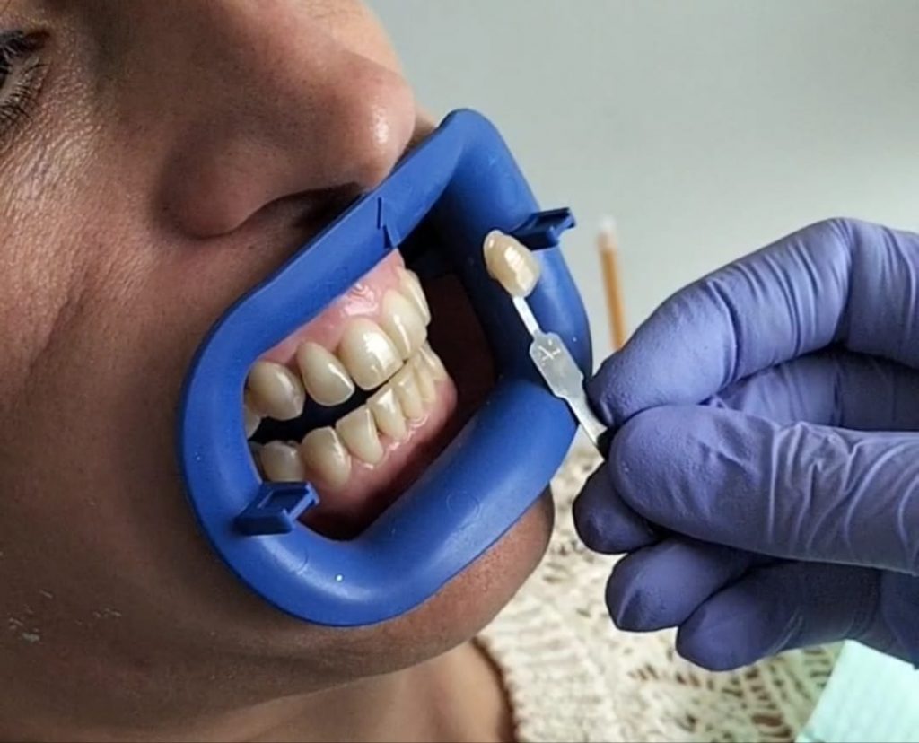 Blanqueamiento dental Pamplona