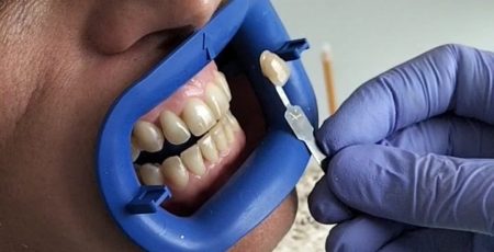 Blanqueamiento dental Pamplona