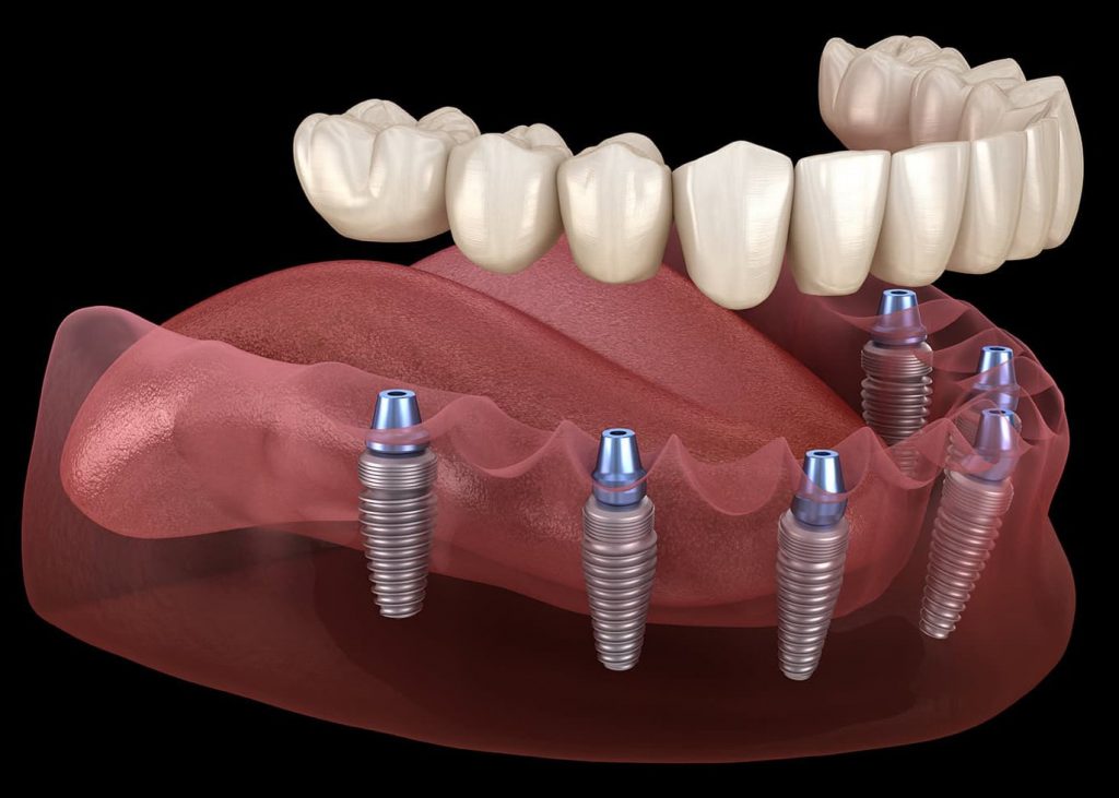 Implante dental Pamplona